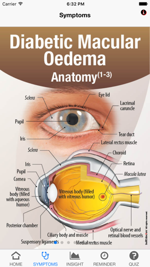 Signs & Symptoms Diabetic Malucar Oedema(圖2)-速報App