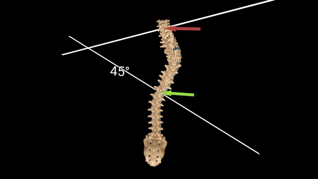 Scoliosis VR(圖3)-速報App