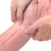 How to Rehabilitate Traumatic Scars-Tips