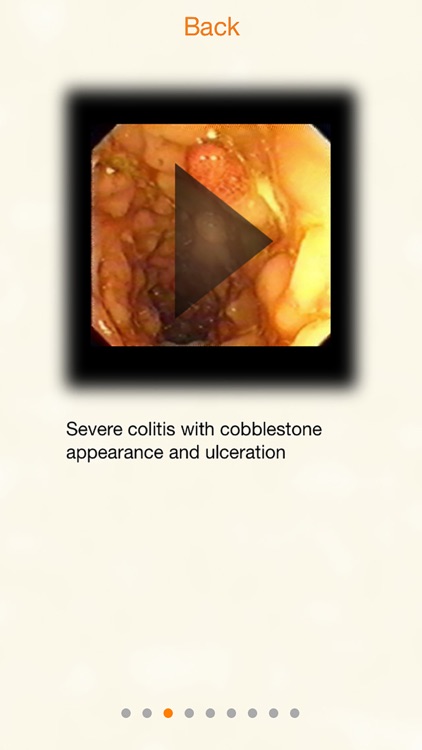 AnswersIn Ulcerative Colitis screenshot-4