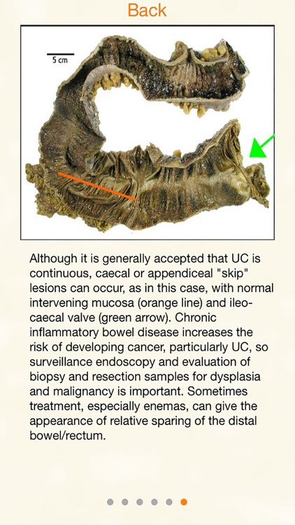 AnswersIn Ulcerative Colitis screenshot-3