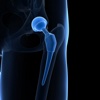 Hip Replacement Guide-Patient Guide