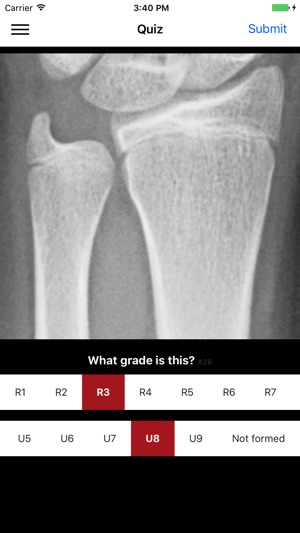 DRU - Distal Radius & Ulna Classification(圖5)-速報App