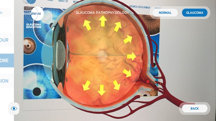 Glaucoma Education screenshot-3