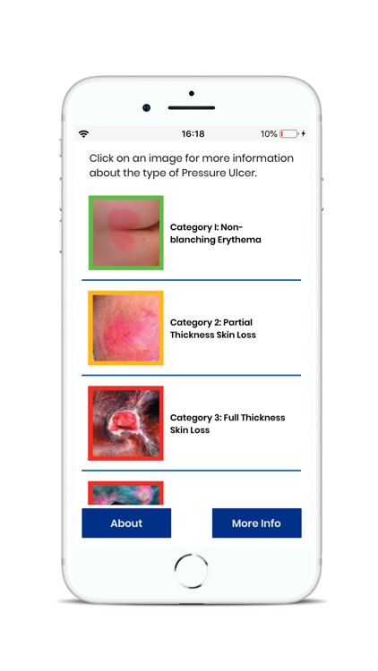 BCG Pressure Ulcer Guide