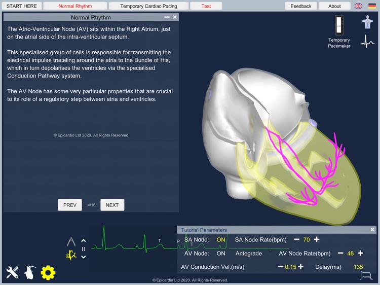 Temporary Cardiac Pacing screenshot-4
