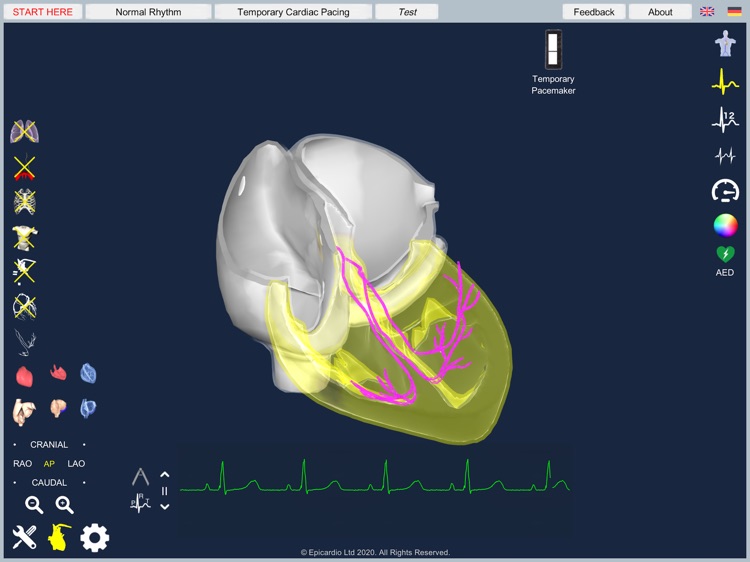 Temporary Cardiac Pacing screenshot-7