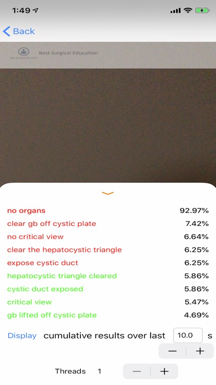 Cholecystectomy AI