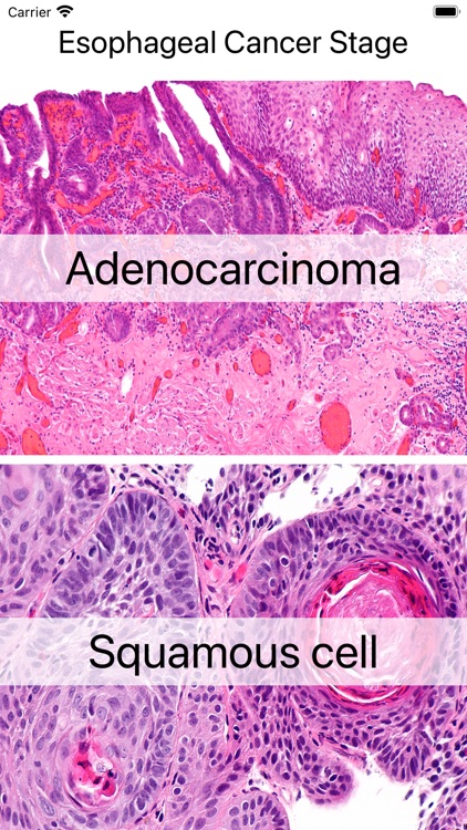 Esophageal Cancer Stage