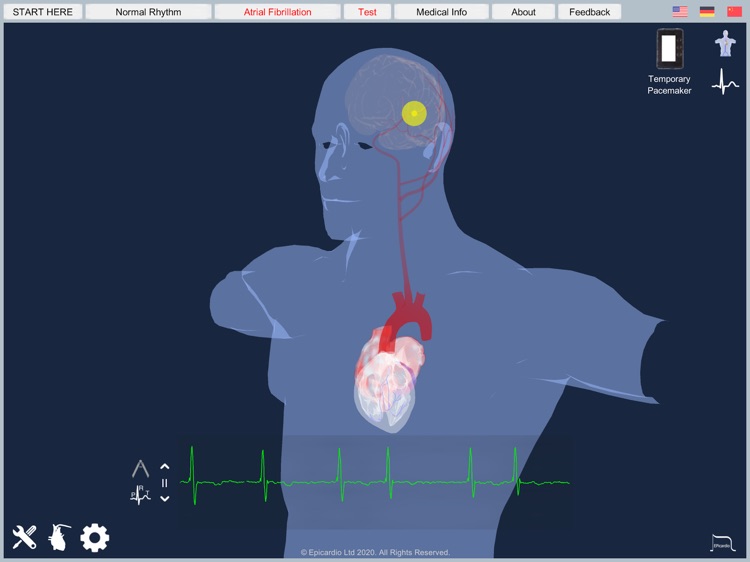 Atrial Fibrillation