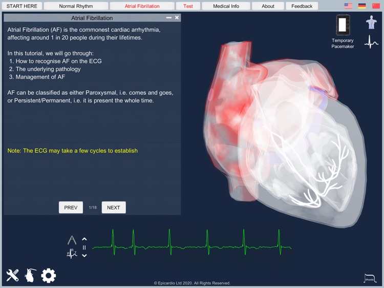 Atrial Fibrillation