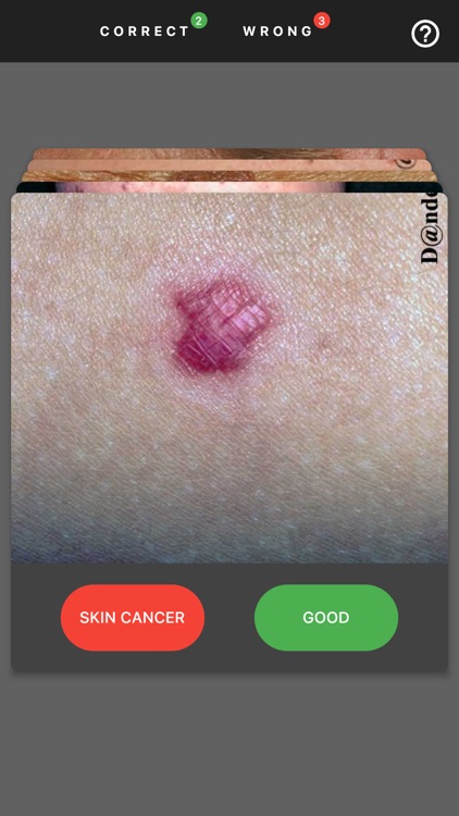 MelanomaExam