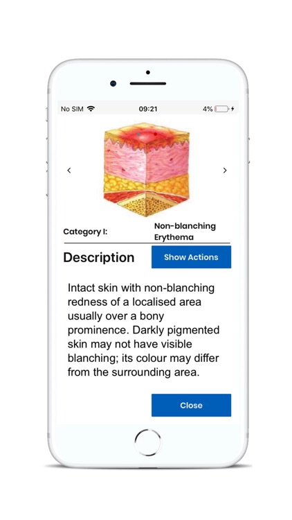 BCG Pressure Ulcer Guide screenshot-3