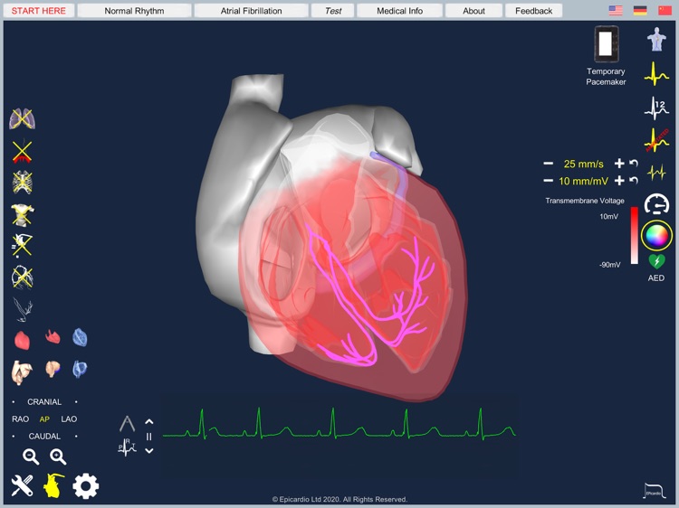 Atrial Fibrillation screenshot-7