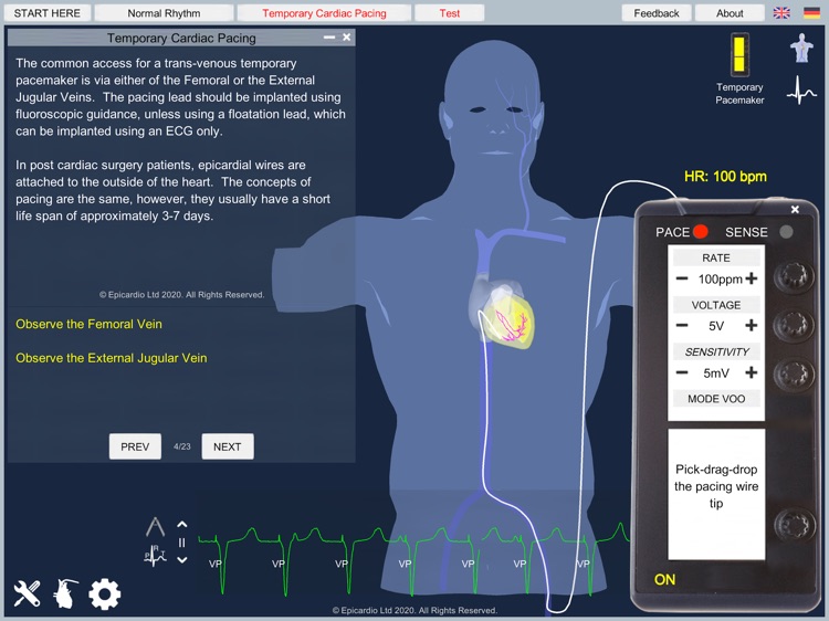 Temporary Cardiac Pacing
