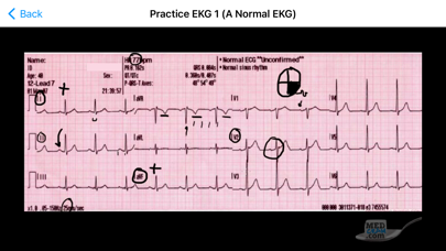 ECG / EKG Explained Clearlyのおすすめ画像6