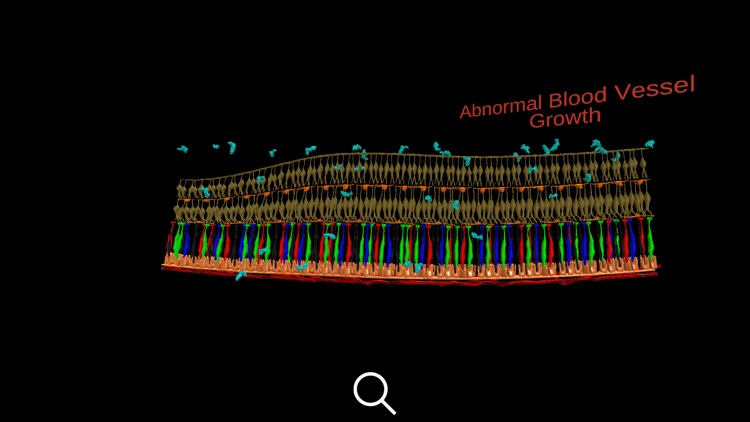 Anti-VEGF’s in DR, AMD & RVO